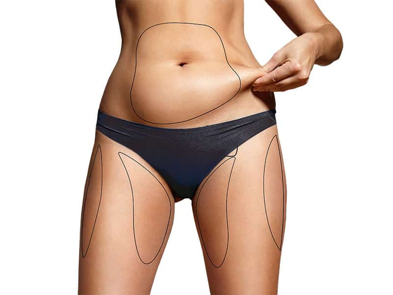 Zahlt Krankenkasse eine Fettabsaugung Wann zahlt Krankenkasse eine Liposuktion