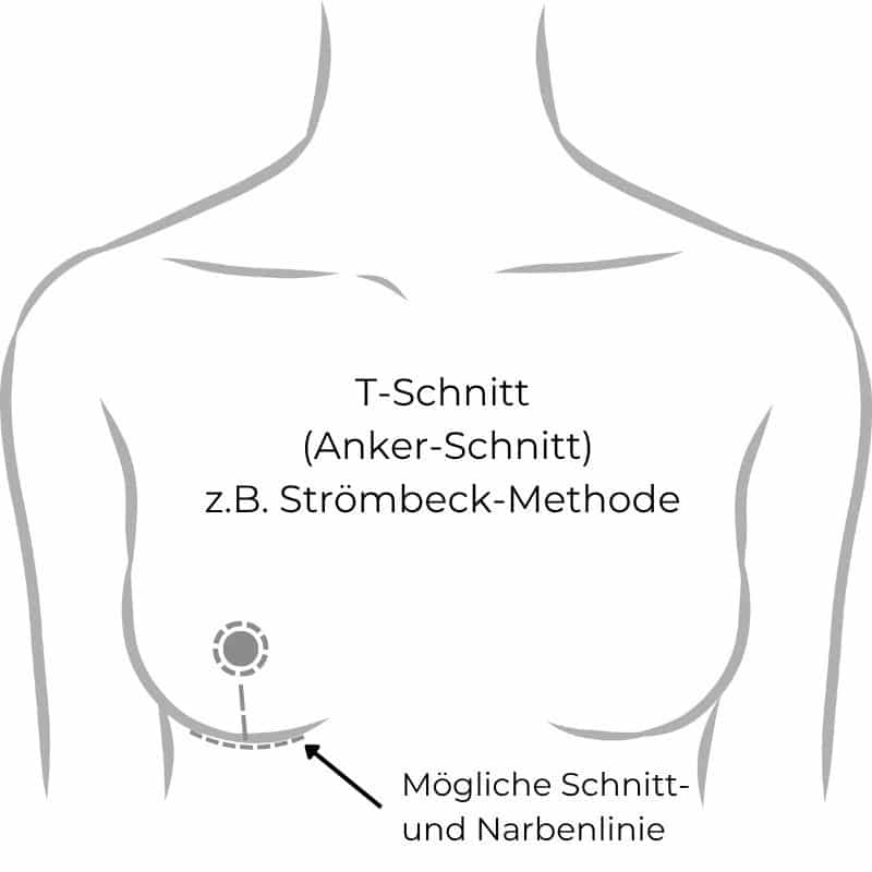 Grafische Darstellung der Brustverkleinerung mit T-Schnitt